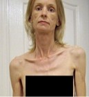 30 kg-ra fogyott az anorexiás nõ - fotóval