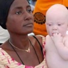Újabb albínógyilkosságok Afrikában