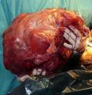 23 kilós tumort operáltak ki a nõbõl - durva fotóval!