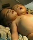 Két fejû csecsemõ született Indiában - csupán néhány óráig élt