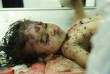 Halálos bombarepeszek ölték meg szegény gyermeket